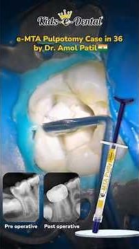 e-MTA Pulpotomy Case | Step-by-Step Clinical Case by Dr. Amol Patil | Pulpotomy procedure | Kids e​