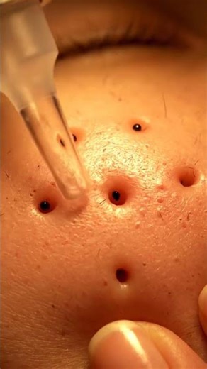 Real Filament Extraction — Gentle Suction ASMR 🔍✨#SkinDetail #CloseUpASMR #FacialASMR #PoreCare