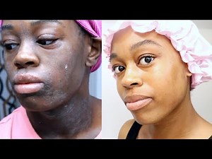 Eczema Treatment Journey | This Skincare Routine Changed My Life | DeSade