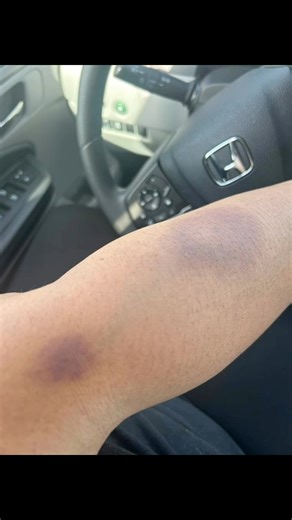 One of the Symptoms that led me to the ER that sooner confirmed my diagnosis Leukemia (ALL) #cancerawareness#surviving-cancer | Mbellish Edwards