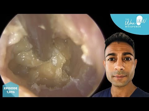 1,096 - Complex Swollen & Infected Ear Wax Removal