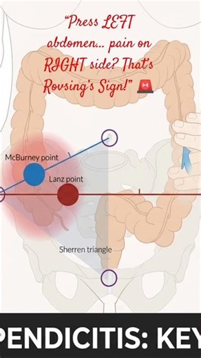 Rovsing’s Sign Explained | Classic Sign of Appendicitis | Clinical Examination #appendicitis