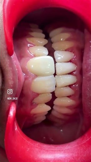 A root canal removes infected pulp to save a damaged tooth, followed by a crown (cap) #dentist