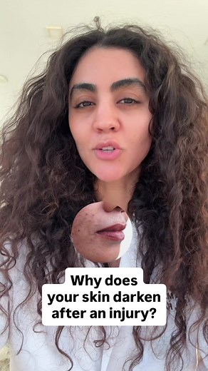Post-Inflammatory Hyperpigmentation Explained