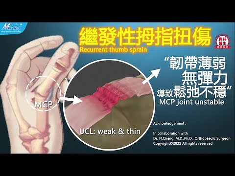 繼發性拇指扭傷(H02 H04b)