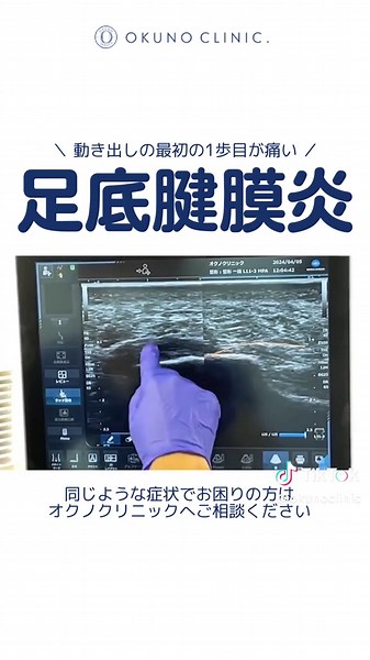長引くかかとの痛みでお困りの方へ #動注治療 がお役にたてています。 ・インソール試したけど変化を感じない ・対外衝撃波を受けてみたけど効果が乏しい かかとの痛みの原因は 異常な血管（ #モヤモヤ血管 ）の可能性も。 モヤモヤ血管 動注治療は 外来で治療でき治療後から日常生活に戻れます。 かかとの痛みでお困りの方は オクノクリニックへご相談ください。 #踵の痛み #かかとが痛い #痛み #専門医 #オクノクリニック #モヤモヤ血管 #札幌 #仙台 #銀座 #表参道 #横浜 #大阪 #三宮 #広島 #博多 #宮崎
