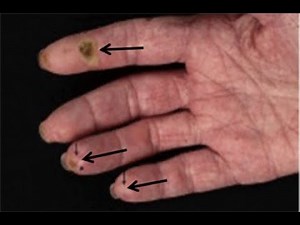 Scleroderma Symptoms – Causes Treatment Pictures Images Signs and Symptoms of Scleroderma