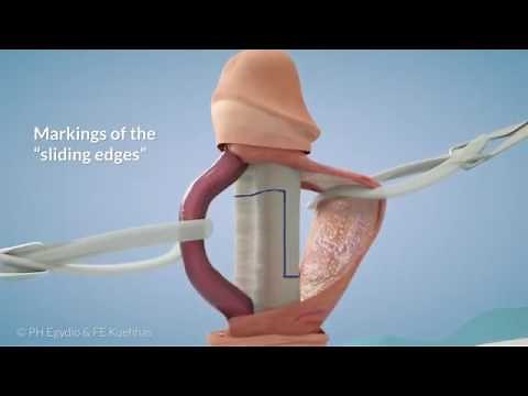 طريقة تركيب الدعامات الذكريه | عملية زراعة دعامة الذكر