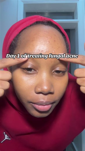 Effective Ways to Eliminate Fungal Acne Fast