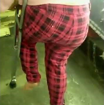 Lovely polio woman with a shortleg.