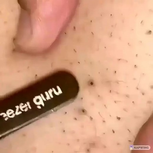 Pimple Popping 2021 on Instagram: "Rate this video 1-10? . . . #pimplepoppingvideos #pimpleremover #pimplevideoos #poppingpimples #popping #drpimplepopper"