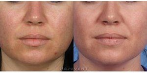 Does dermaplaning actually shave the years off of your face?