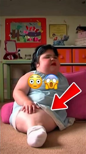 Born With Mermaid Tail😨 #sirenomelia #shorts #shortsfeed #shortsvideo #ytshorts #viralshorts #usa