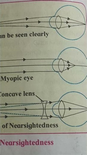 myopia/ Nearsightedness defect of vision - use spectacles with concave lens