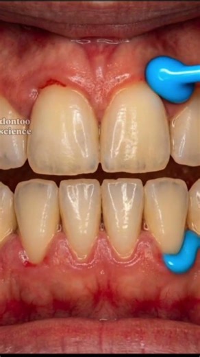 If your teeth whitening isn’t working, the problem may start before it even begins