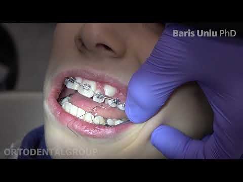 Open Coil Spring Installation