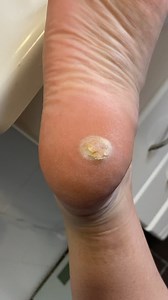 Wacky Wednesday submission: This is my corn after a week of wearing a removal bandage. It also affected the surrounding skin. So off it all came.