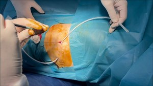 Indwelling pleural catheter insertion technique