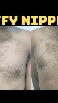 Grade 1 Gynecomastia with puffy nipples| Puffy nipples treatment in Ranchi| #puffynipple