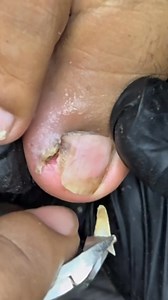 Can’t imagine the discomfort | Ingrown Queen Vlogs