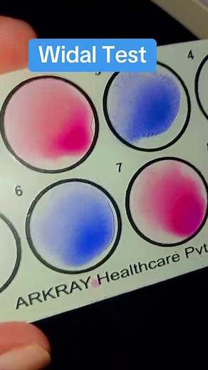 Understanding the Widal Test for Typhoid Fever Diagnosis