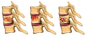 Kyphoplasty - Interventional Spine & Pain Management - Encinitas, CA.