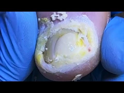 How To Trim Toe Warts Step By Step! Remove Dead Skin Fungus