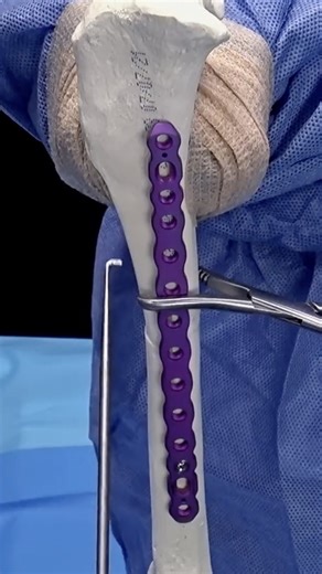 Arthrex Vet Systems on Instagram: "Sean Murphy, DVM, DACVS-SA, demonstrates the OrthoLine™ fracture management system on a canine tibia using a plastic bone model. Watch the full video at the link in our bio. #ArthrexVetSystems #Innovation #MedicalEducation #Veterinary"