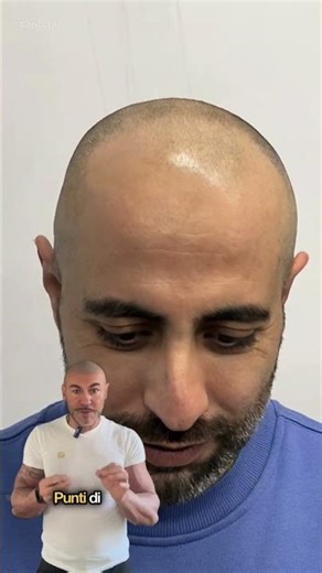 Da calvo a rasato… e quella cicatrice che finalmente non pesa più 🖤