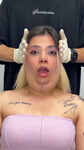 Watch this advanced V-Line contouring and double chin liposuction procedure, designed to reduce.