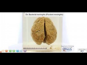 Brain - Meningitis