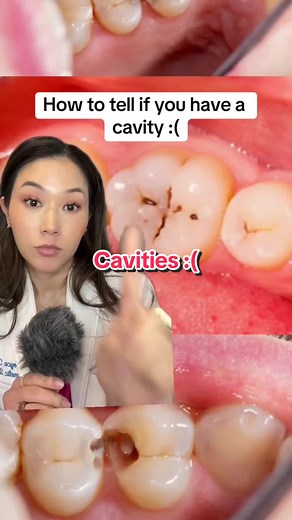 How to Spot Cavities and Tooth Decay: A Guide