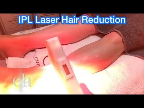 Legs IPL Laser Hair Removal Treatment