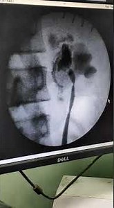 Left Retrograde pyelogram (RGP) - Dye extravasation at PUJ level