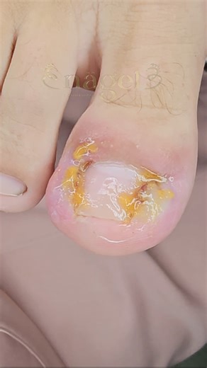 Nathalie Naviliat on Instagram: "Assista o vídeo completo no YT: UM PACIENTE E 2 PROCEDIMENTOS | Paciente com muita dor #satisfying #viral"