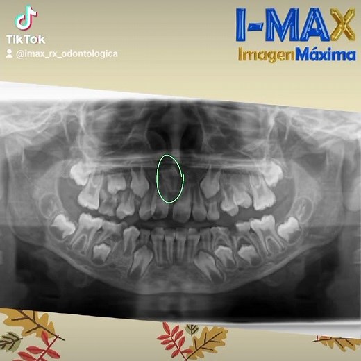 RADIOGRAFIA PANORÁMICA EN DENTICIÓN MIXTA