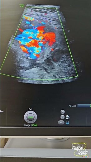 Morbidly Adherent Placenta & Central Placenta Previa || Ultrasound