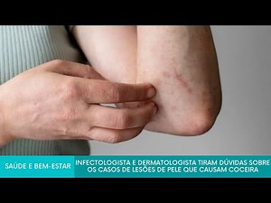 #AoVivo | Infectologista e dermatologista falam sobre os casos de lesões de pele que causam coceira