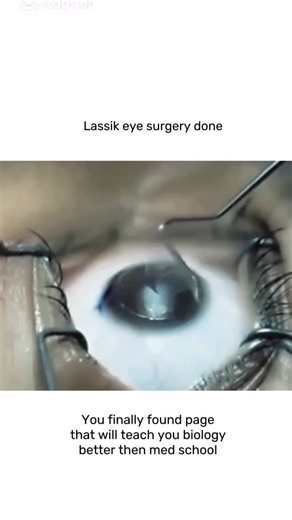 leverage_club | LASIK eye surgery, explained 👁️🔬 LASIK (Laser-Assisted In Situ Keratomileusis) is a laser procedure that reshapes your cornea so light... | Instagram