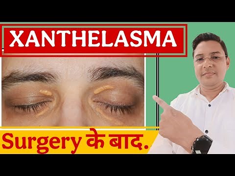5 Critical Mistakes to Avoid After Xanthelasma Removal Surgery