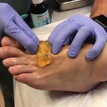 ganglion cyst surgery