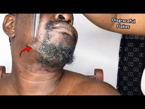 Extreme Flakes and Dandruff On My Beards..💙