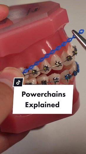 Understanding Power Chains in Orthodontics