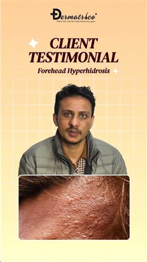 I Tried Botox for My Sweaty Forehead, Here's What Happened