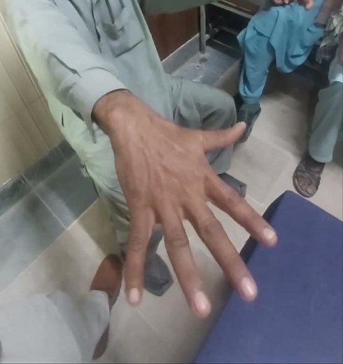 Benign essential tremor