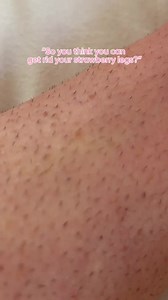 9.3K views | Are you tired of having little red bumps on your legs? It's your RAZOR. Shaving can cause strawberry skin & ingrown hairs! With Lumi, all you have to do is zap away the hair and stop the follicle from becoming clogged again! Best of all, no more shaving after you complete your treatments! Tell us... how would you feel if your legs were blemish-free? | Rose Skin Co | Facebook
