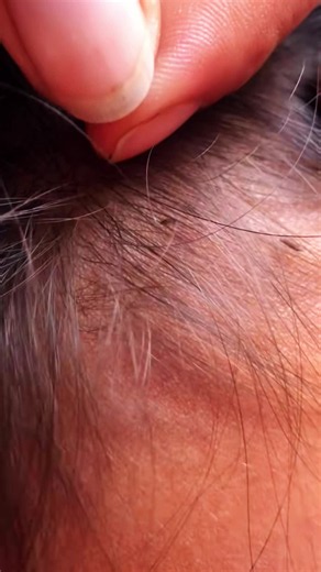 Lice Treatment and Removal: Effective Home Hair Care Tips