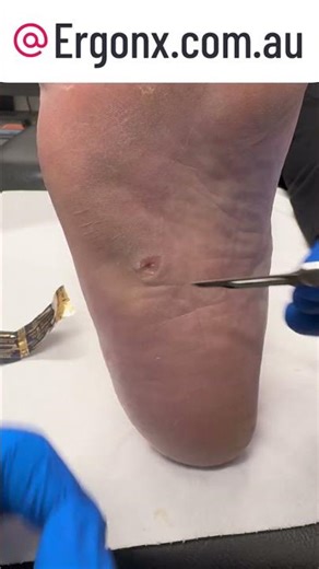 Satisfying Corn Removal from Carpenter's Foot #FootCare #Satisfying