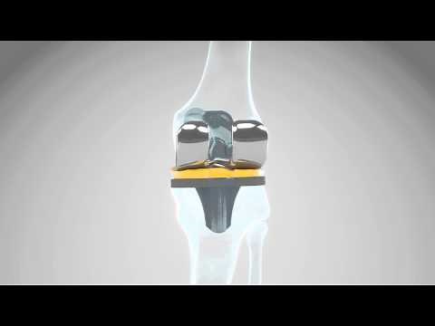 DJO Surgical - 3DKnee™ System