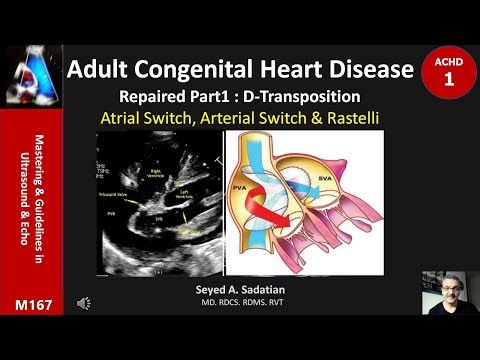 ACHD 1: D-Transposition repaired; Atrial Switch, Arterial Switch & Rastelli
